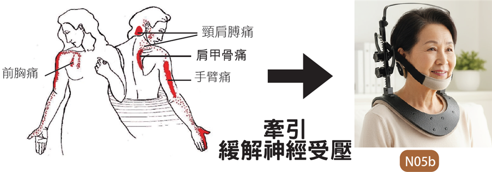頸椎神經受壓